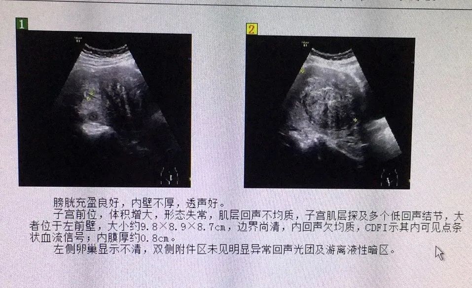 子宮如孕20周打開腹腔到處都是小結節