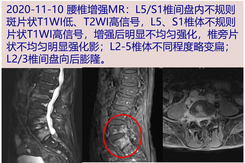 探案丨发热腰疼好不了原来这只妖孽在作怪
