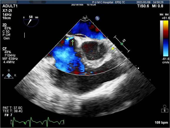 術前經食管超聲心動圖檢查發現房間隔有卵圓孔未閉,且存在左向右分流.