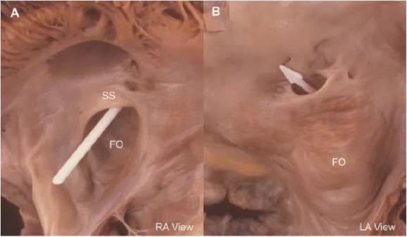 据心内科主治医师黎婧懿介绍,卵圆孔是在胚胎发育期心脏左右心房之间