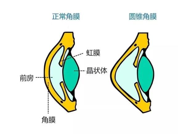 科普角膜地形圖精準導航方便安全