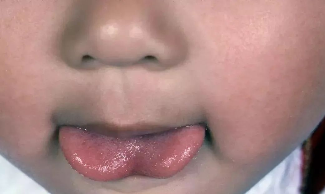 舌根指的就是舌系带,就是我们舌头翘起时,连接着舌头和口腔底部的薄