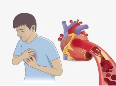 痛在别处的心梗信号你千万不能忽视
