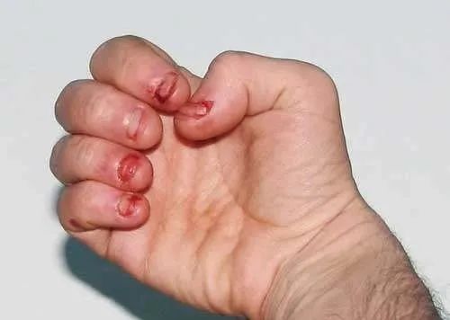 忍不住地撕死皮抠指甲会不会发展成可怕的强迫性皮肤剥离症