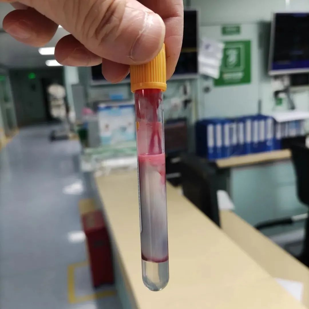 护士抽血时发现患者的血液出现明显的分层,上面浮着一层乳白色的脂层.
