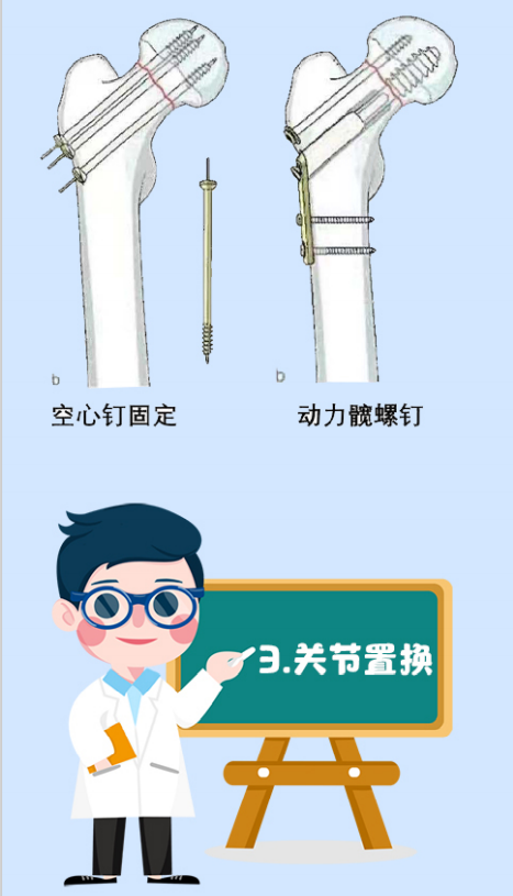 关节置换1)适宜人群:通常老年患者均采用髋关节置换.