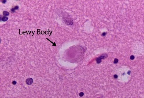路易体痴呆的遗传研究支持与阿尔茨海默病和帕金森病的联系