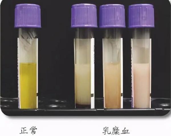 50岁的阿姨抽出猪油血医生提醒春节饮食要注意