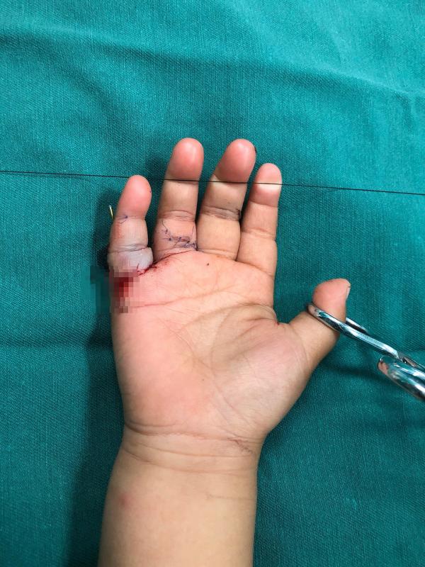 发动机皮带咬断2岁幼童右手小指海医二院成功缝合目前患儿恢复良好