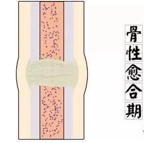 在這個階段形成的骨痂,逐漸的轉變成正常的骨小梁,使肢體能夠進行一