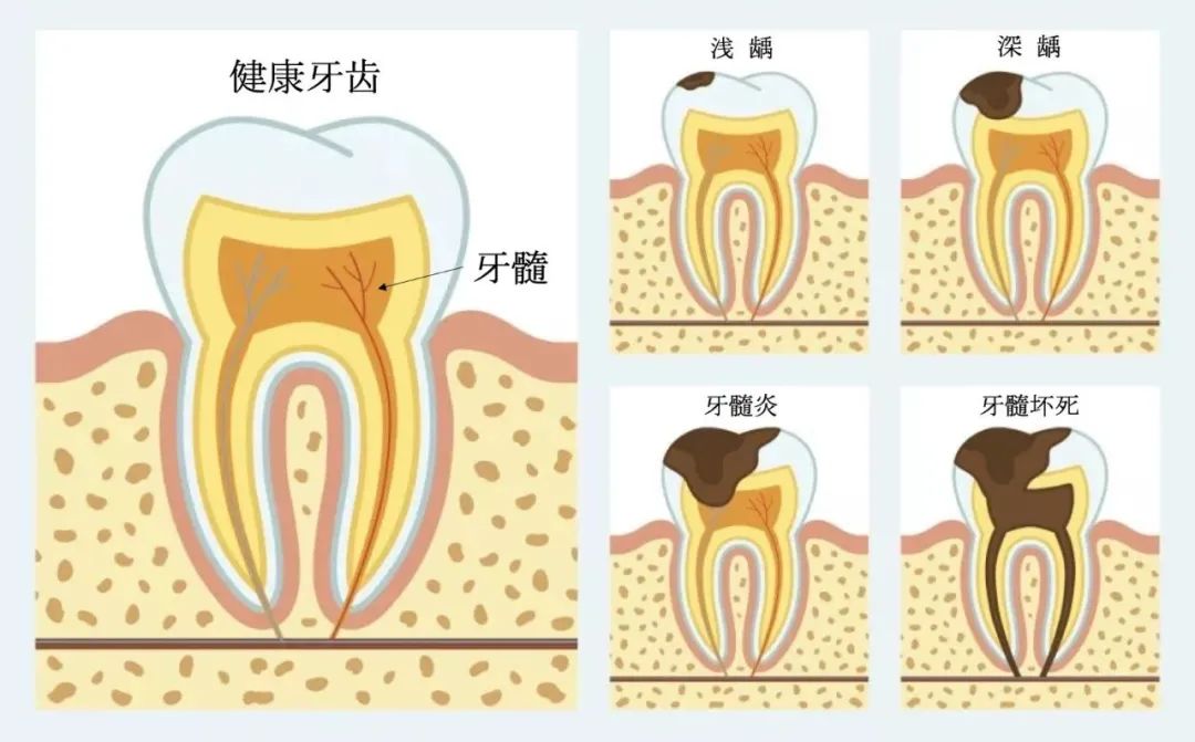 抽牙髓过程图解图片