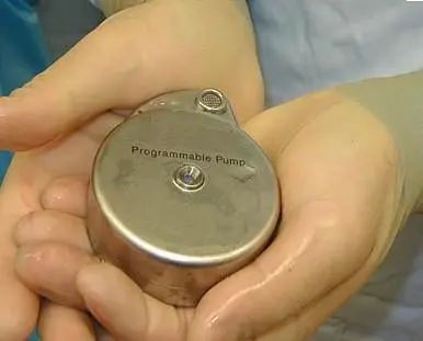 【健康百科】癌痛的终结者:植入式吗啡泵