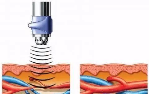 冲击波的原理今天我们就一起来认识一下冲击波疗法是一种源自欧洲的