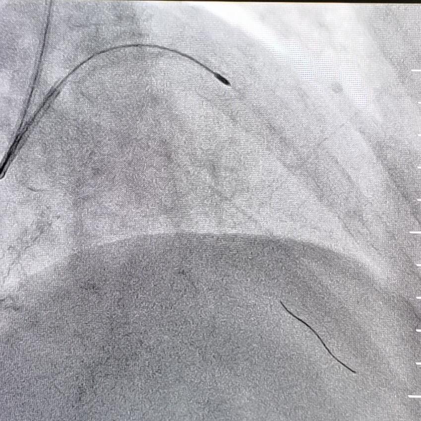 【助力】血管内超声 冠状动脉内膜旋磨术,为患者提供精准治疗