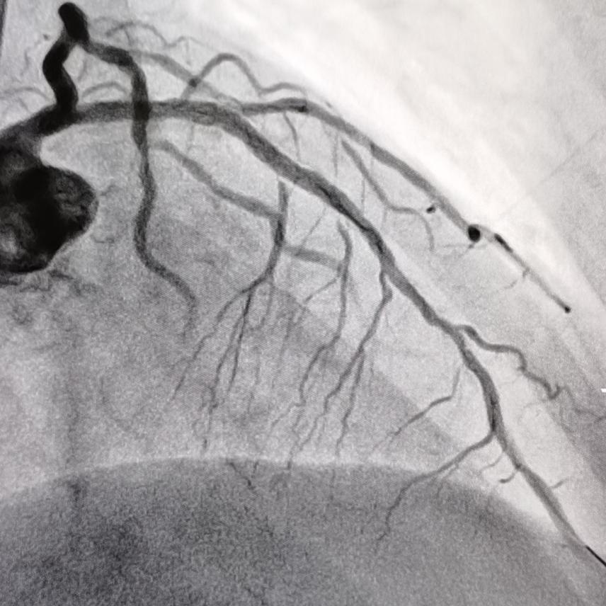 【助力】血管内超声 冠状动脉内膜旋磨术,为患者提供精准治疗