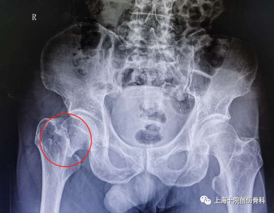 入院检查,x线片显示赵大爷右股骨颈完全骨折,移位明显,3d成像证实"