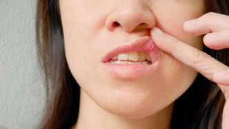 口腔溃疡反复发作，竟被查出舌癌