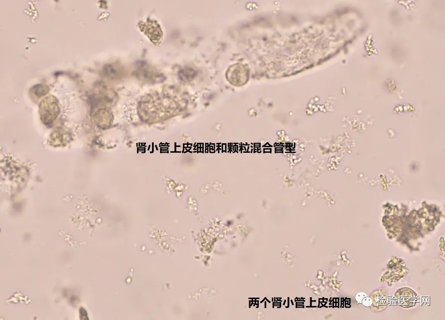 警惕這類病例,尿蛋白不高甚至陰性,卻檢出管型_湃