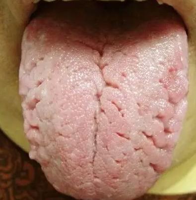 缺维生素b2的舌头图片图片