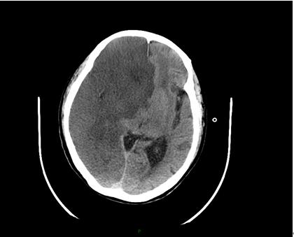 急请神经内科会诊诊断大面积脑梗死小脑幕切迹疝右侧脑梗塞(图2),加大