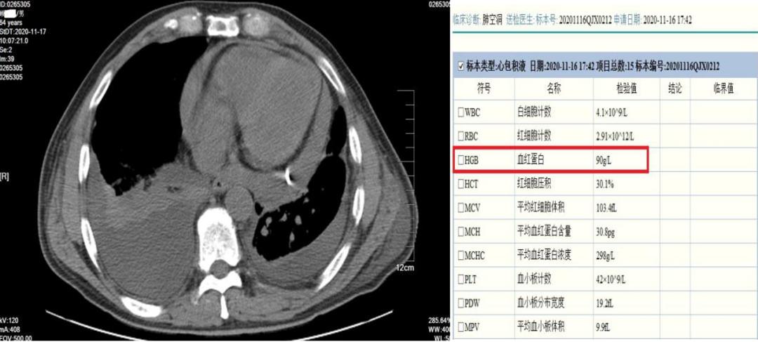 引流胸水及心包积液,血常规检测发现患者血红蛋白达到90g/l.