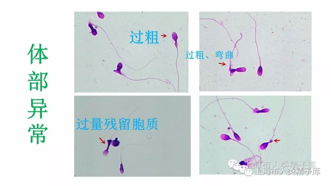 锥形头精子图片