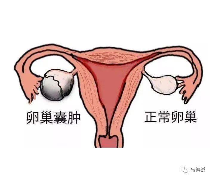 生理性卵巢囊肿图片