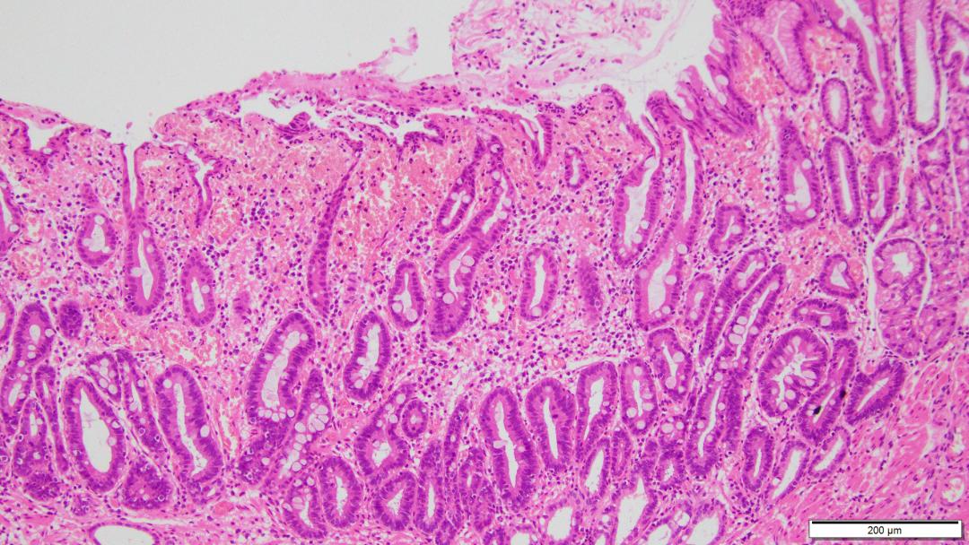 肠化胃黏膜病理图像当胃黏膜层的上皮细胞受到细菌,食物,胃酸的刺激而