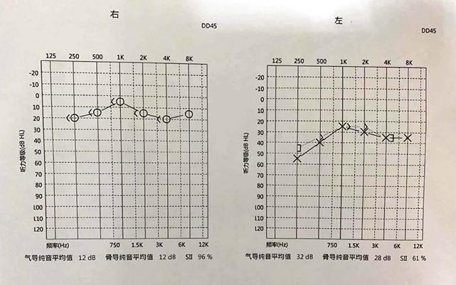 世界听力日游泳回来孩子聋了这个问题好多家长不重视