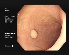 身体出现这7个症状请警惕结肠类癌