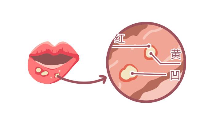 有黄色的假膜 红:溃疡边缘有一圈的充血带;口腔溃疡的4大典型特征