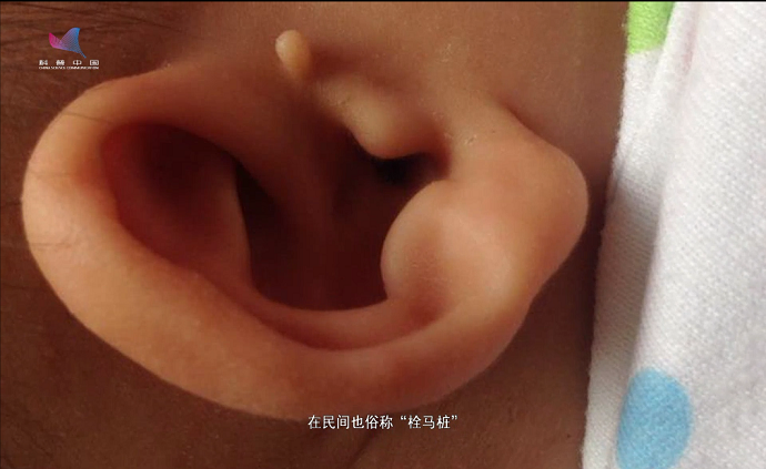 耳朵上的“小凸起”能切除吗？