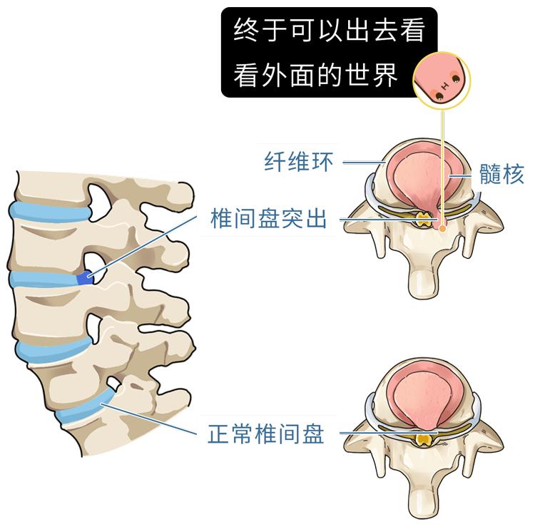 从而引起腰椎间盘突出让果冻状的髓核流出里面的纤维环就会破裂当椎间