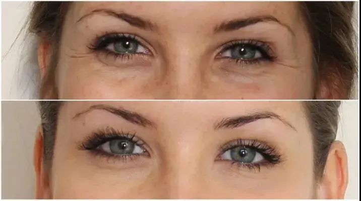 蒲公英鱼尾纹上睑松弛你害怕眼部衰老吗