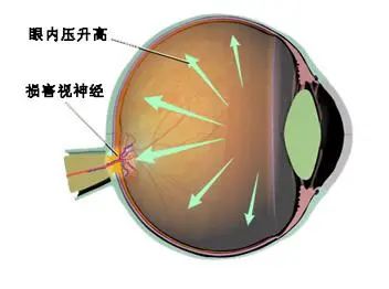 淺談一種難治性青光眼——新生血管性青光眼