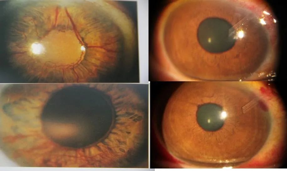 是青光眼阀门植入术后照片,患者角膜水肿消退,虹膜新生血管基本消退