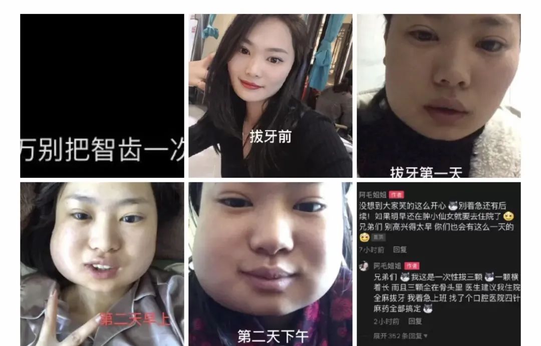 智齿必须上下一起对称着拔吗 身体 澎湃新闻 The Paper