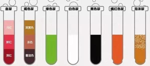糖尿病患者日常的6个表现,要重视,这可能是尿毒症的信号