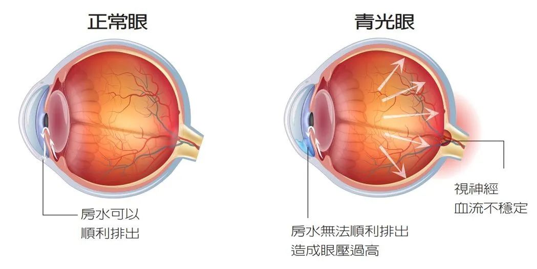 青光眼视野变化图图片