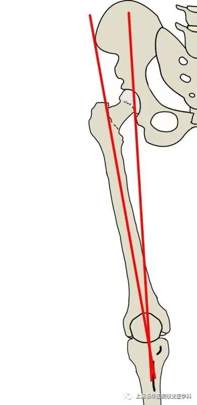 q角是指从髂前上棘到髌骨中点连线代表股四头肌牵拉力线,从髌骨中点到