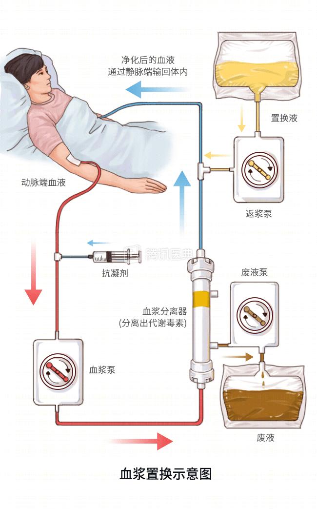 血液净化cbp图片