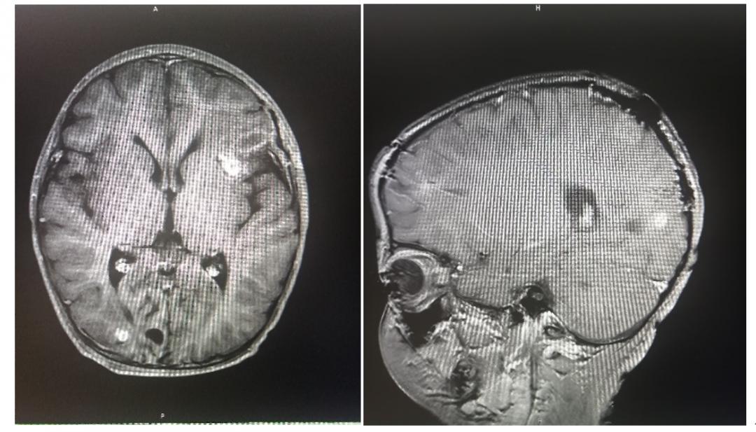 脑脓肿影像学表现图片
