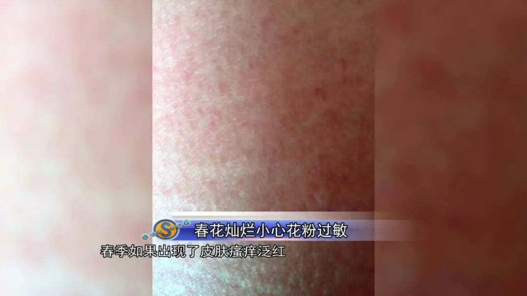 街坊-颜先生:我自己有一点花粉过敏,平时皮肤可能会有红疹,瘙痒.