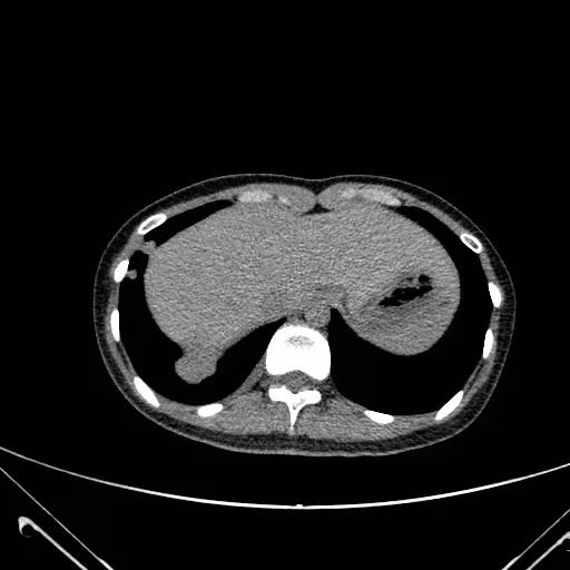 再续未来中国医大一院胸外科联合肝胆外科完成一例复杂膈肌肿瘤手术