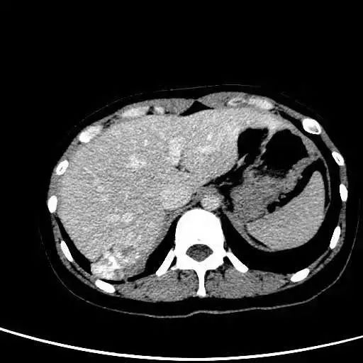 再续未来中国医大一院胸外科联合肝胆外科完成一例复杂膈肌肿瘤手术