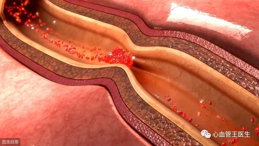 图已经恢复正常,没有心肌梗死的痕迹,我们考虑可能是心血管痉挛导致的