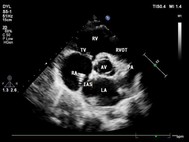 常规二维超声心动图图片