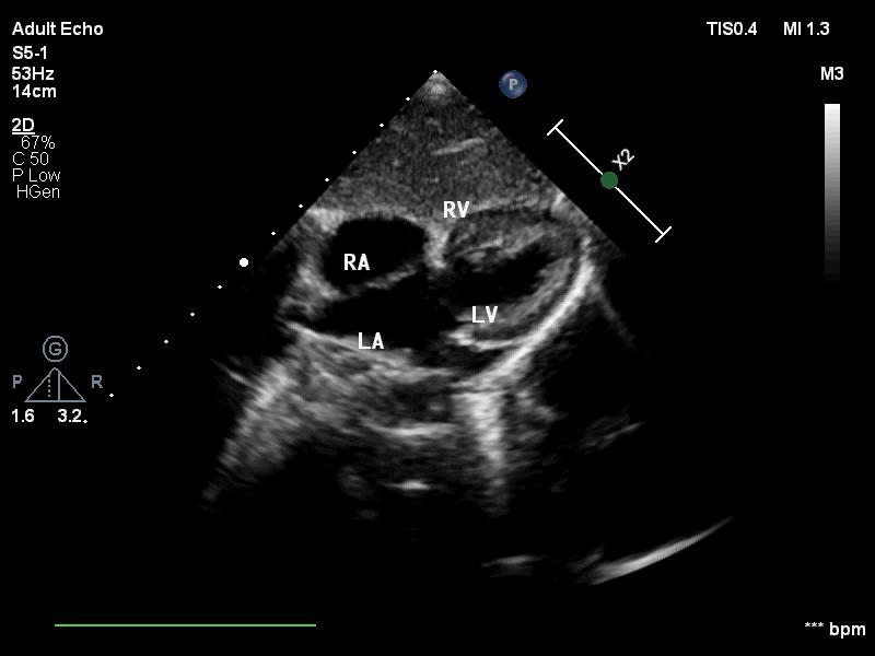 常规二维超声心动图图片