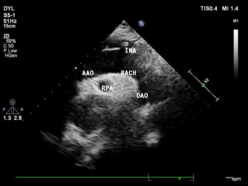 超声心动图aao:升主动脉 rach:主动脉弓 dao降主动脉rpa:右肺动脉ina