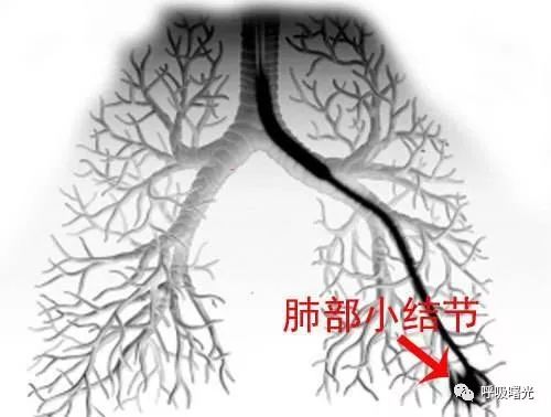体检时发现了肺小结节该怎么办